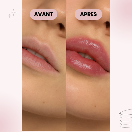 Derma Roller – Volume Naturel Instantané